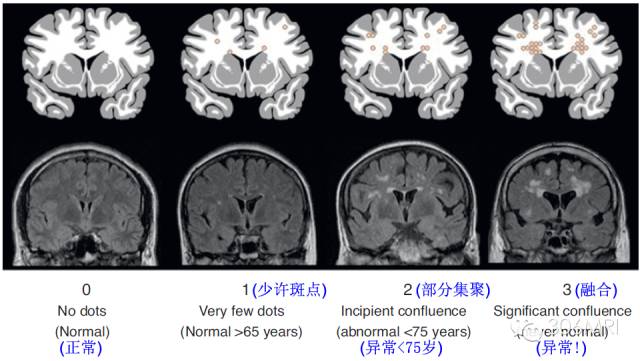 腦白質區內mri斑點狀異常信號解讀