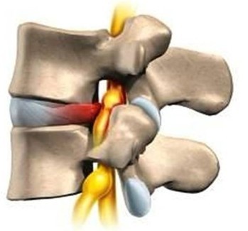 最好的辦法是鍛鍊椎間盤周圍的肌肉和韌帶,從而讓椎間盤逐漸回覆原位.