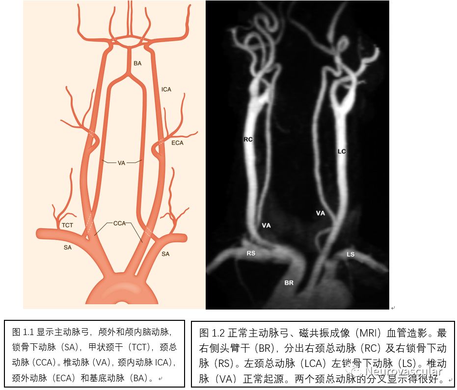 脑血管造影读片基础图谱颈内动脉颈外动脉主动脉弓图谱