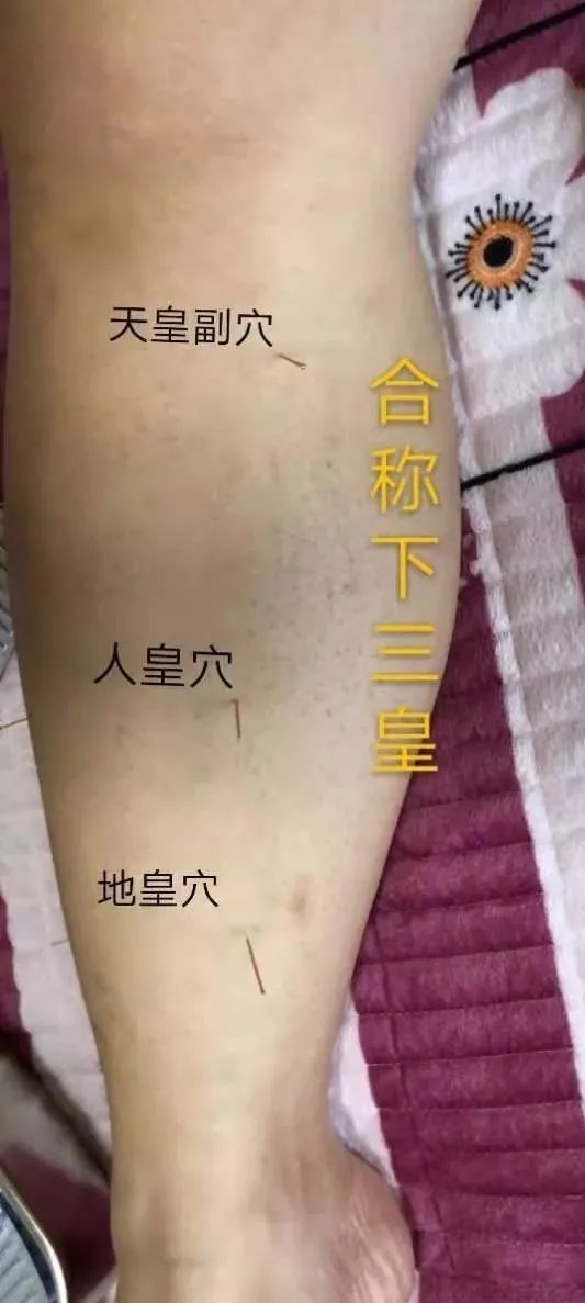 【下三皇】主治:肾炎,四肢浮肿,糖尿病,淋病,阳痿,早泄,遗精,滑精蛋白