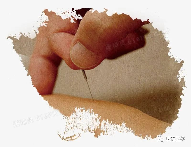 留针1—2小时.以睡前针刺为宜.