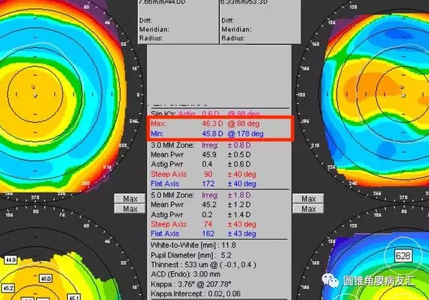 原快速入门读懂角膜地形图圆锥课堂第一讲