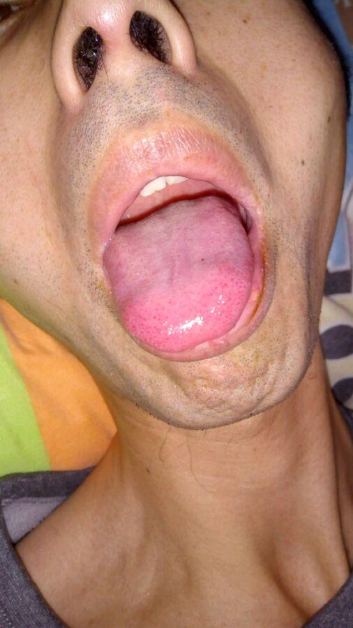 肾病舌头的症状图片图片