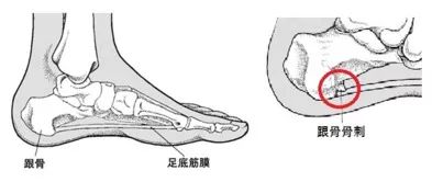 1,跟骨的骨刺:长期的压力刺激或者炎症,会导致跟骨下方偏内筋膜附近处