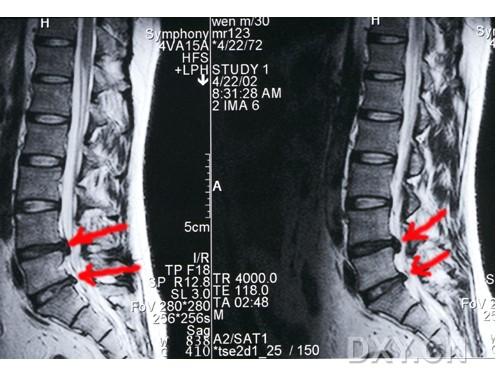 如何正确认识腰椎间盘突出症绝对秘方腰突坐骨神经痛给你提供一个治疗