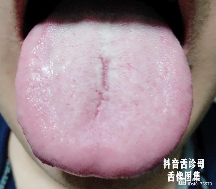 舌头中间有条沟图片图片