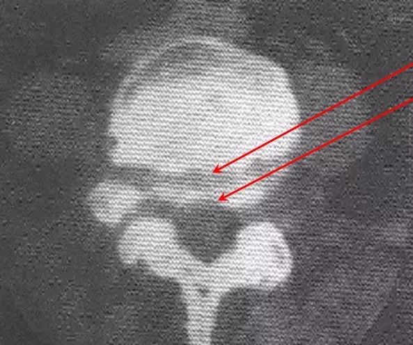 滑脱椎体"双边征"椎管前后径延长,可呈"双管征".