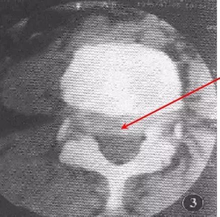 滑脱椎体"双边征"椎管前后径延长,可呈"双管征".