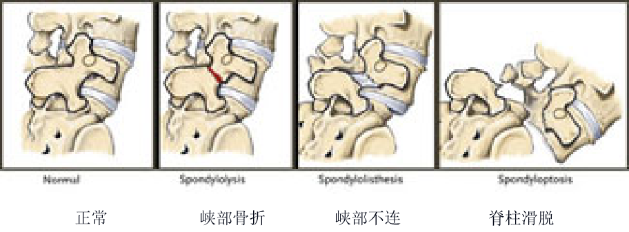 腰椎滑脱的影像学表现及治疗，全在这里了！