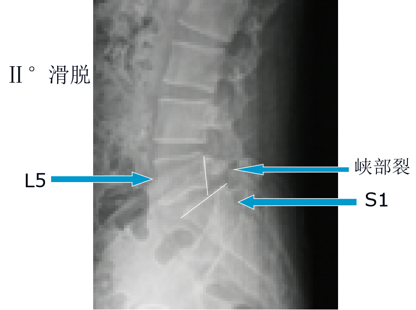 腰椎滑脱的影像学表现及治疗全在这里了