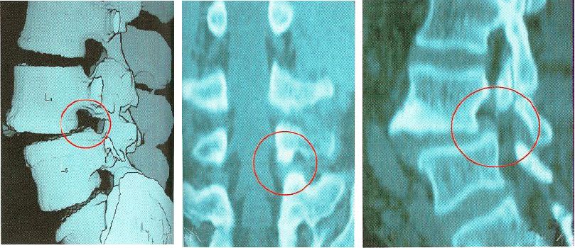 腰椎滑脫的影像學表現及治療全在這裡了