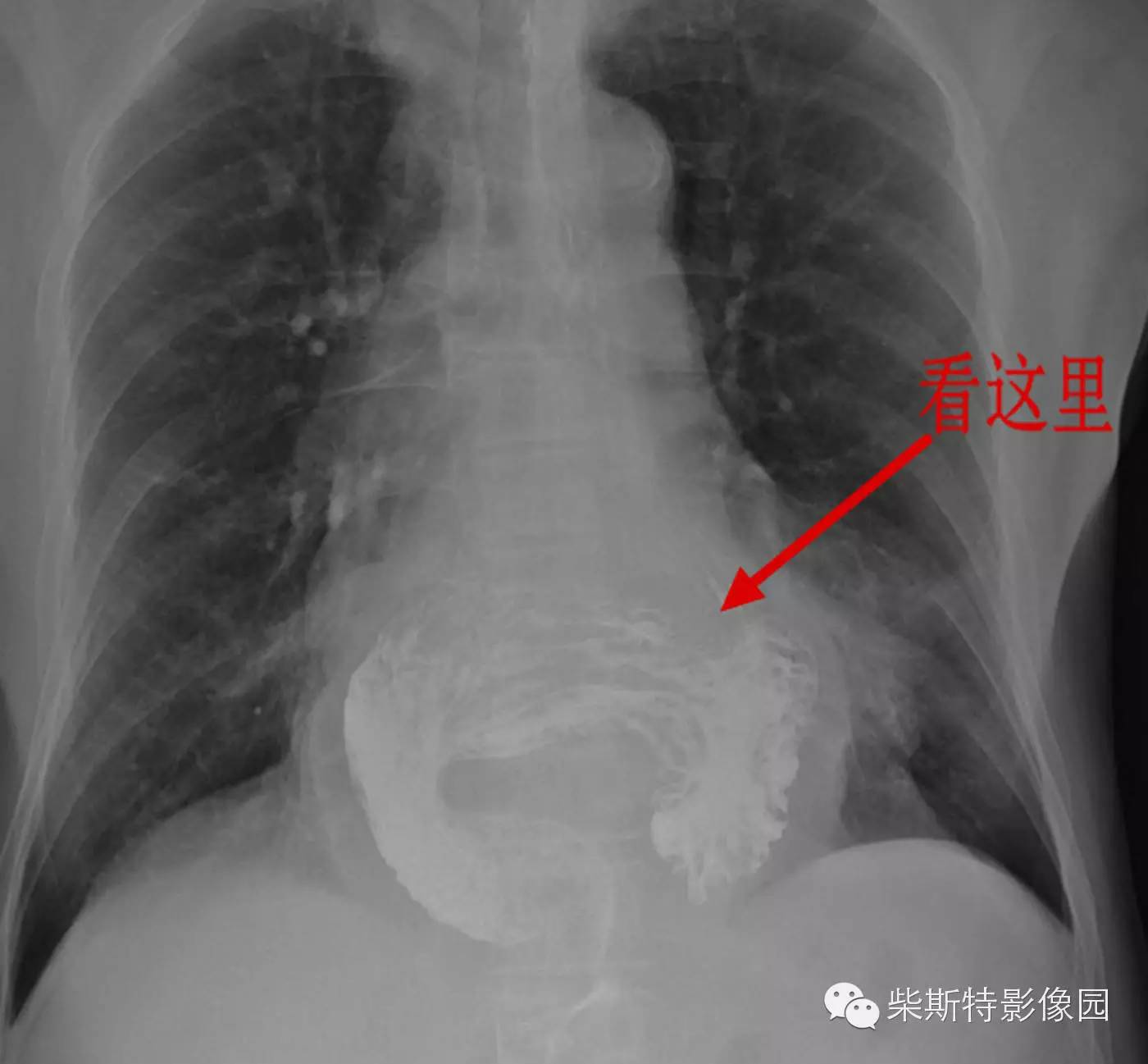 胸片表现:在胸部平片上显示为膈上心影重叠处的含气疝囊影,立位可见液