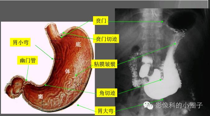 胃角解剖图高清图图片