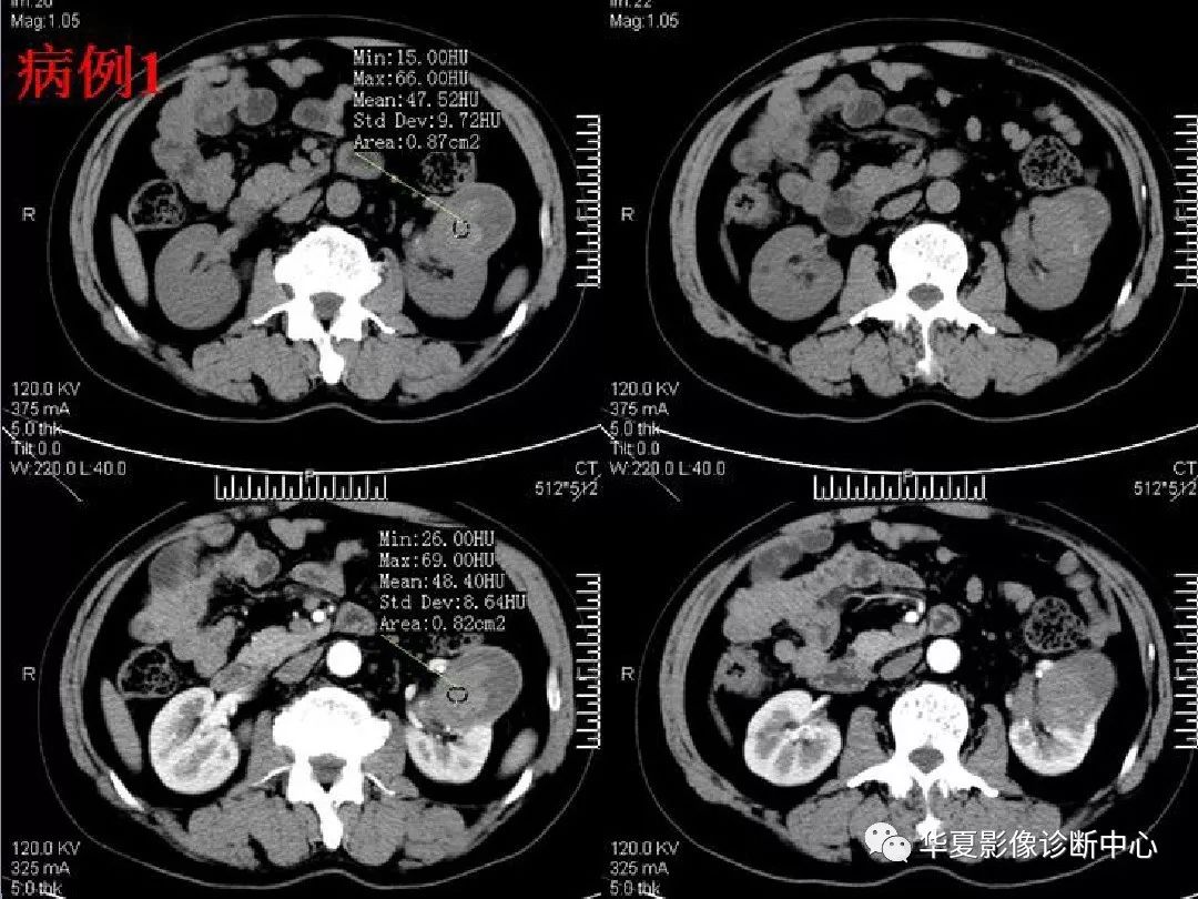 影像基礎腎臟乏血供腫瘤的ct表現與鑑別