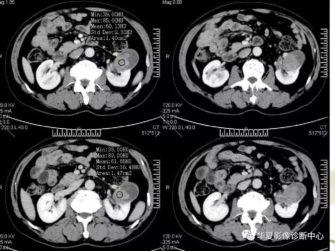 影像基礎腎臟乏血供腫瘤的ct表現與鑑別