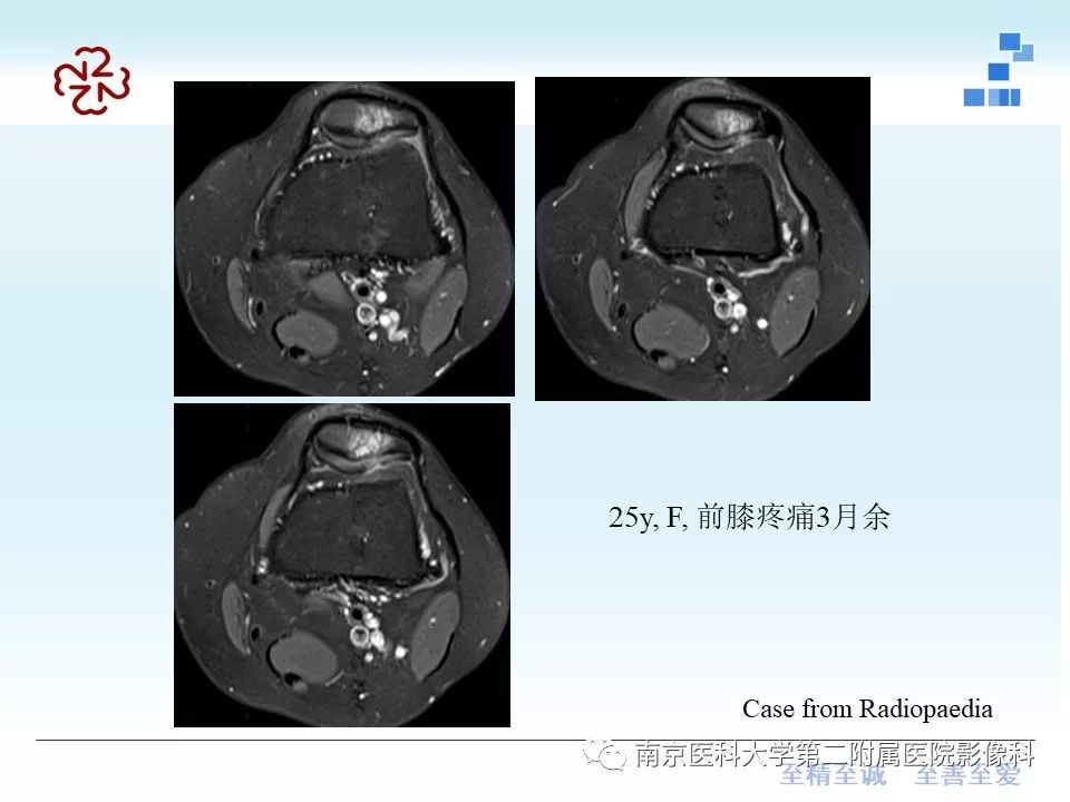 髌骨软化核磁共振图像图片