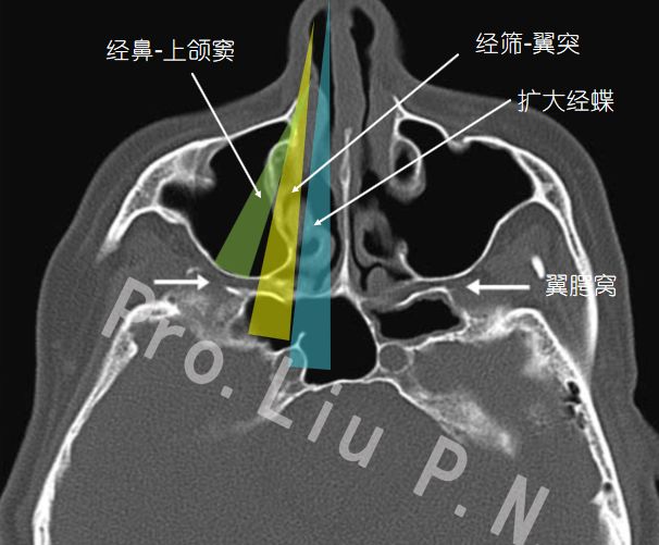 巖尖下區(咽鼓管區),翼顎窩區,顳下窩區,蝶骨大翼腹側區,咽旁間隙區