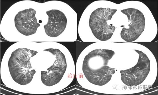 肺部弥漫性磨玻璃病变的hrct诊断