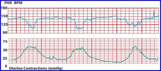 胎心监护怎么看?精准判读全指南