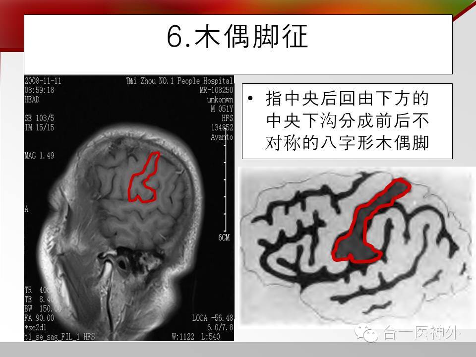 額下回及其3分部1.外側裂及其5分支矢狀面腦溝回七大徵象10.中央角9.