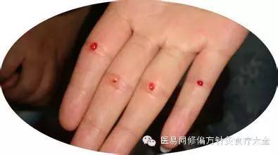 不用扎针泡手治疗小儿痞积疳积消化不好不思饮食等