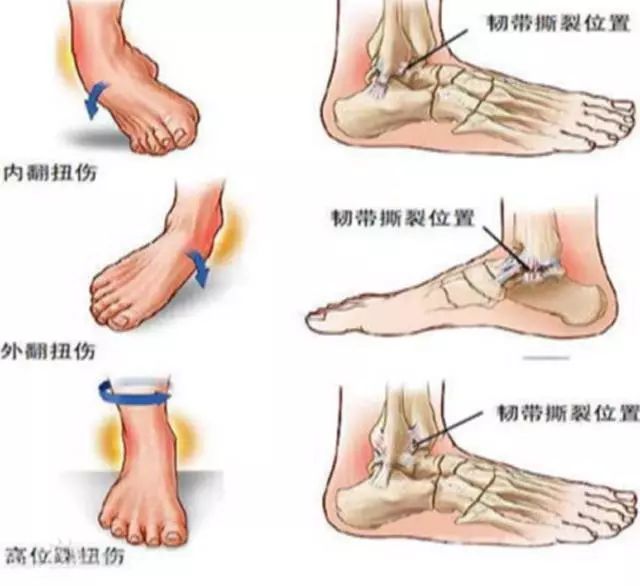 踝关节扭伤的临床表现包括伤后迅即出现扭伤部位的疼痛和肿胀,随后