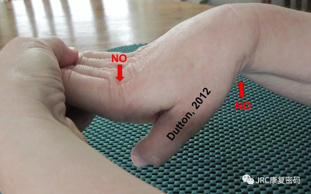 脑卒中偏瘫手功能的阶段性作业治疗