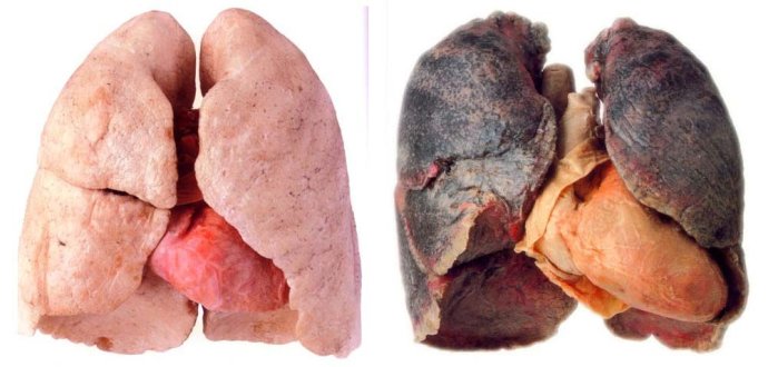 一个长期吸烟者的肺图片