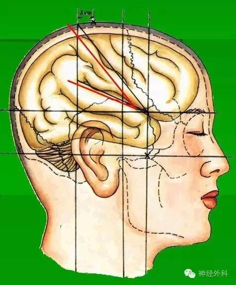 矢状线:眉间至枕外隆凸的连线.