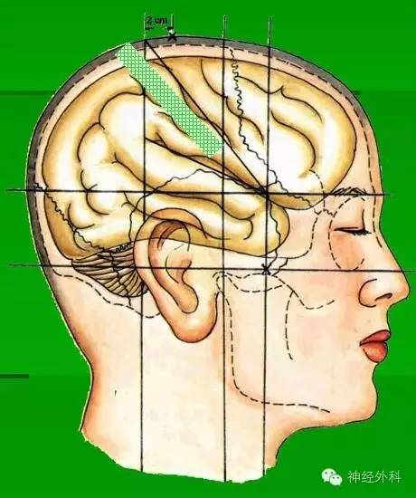 25cm處向外側引一條長1.25～2.25cm的線,此線即為頂枕溝的體表投影.