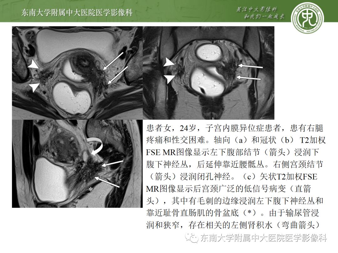 精彩推荐子宫内膜异位症影像表现