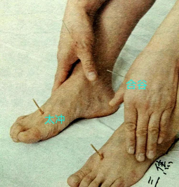 百忍堂独针针法汇编