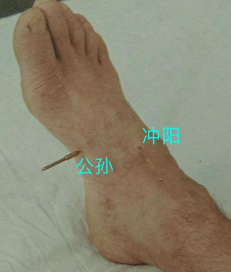 百忍堂独针针法汇编