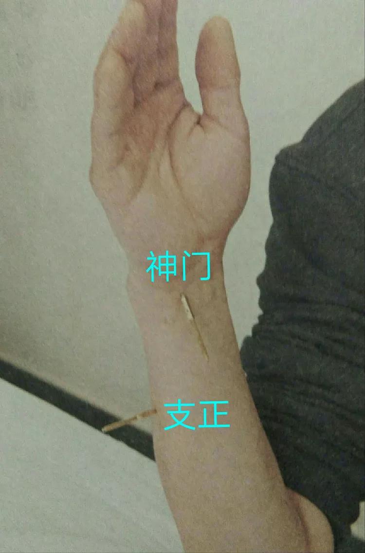 百忍堂独针针法汇编