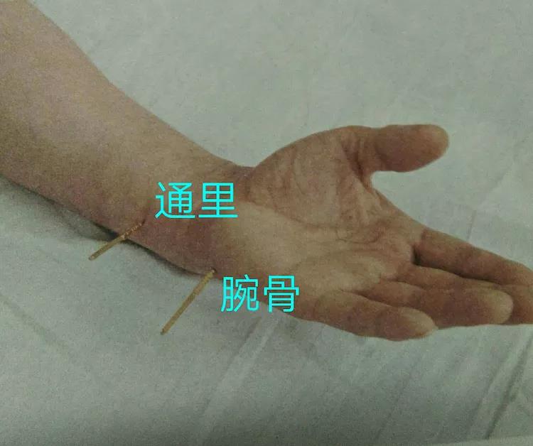 百忍堂独针针法汇编