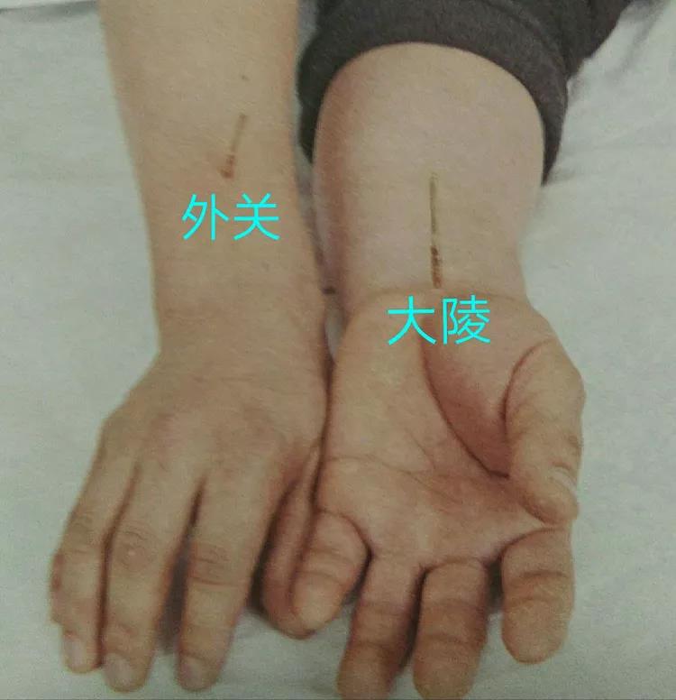 百忍堂独针针法汇编