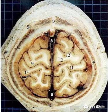 1,頭皮(s)皮膚(c)結締組織(a)帽狀腱膜(l)疏鬆組織(p)顱骨外骨膜意 