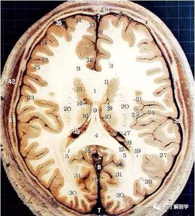 1,頭皮2,顱蓋 3,大腦縱裂 4,胼胝體幹5,胼胝體壓部 6,上矢狀竇 7,大腦