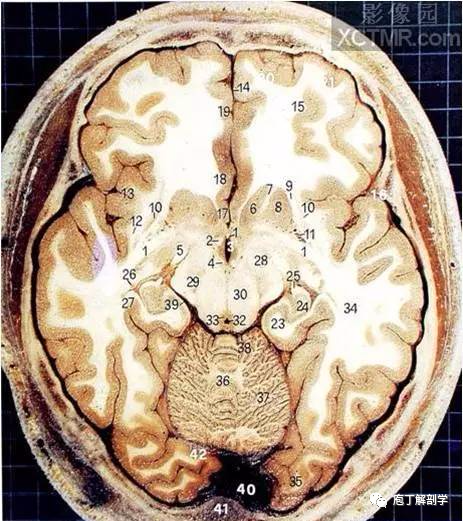 經典大體顱腦斷層解剖圖橫斷面