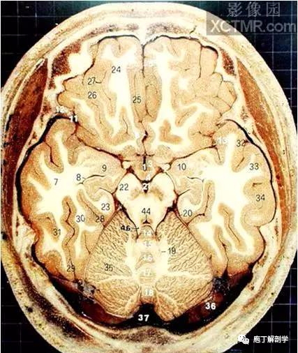 經典大體顱腦斷層解剖圖橫斷面