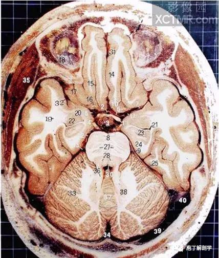 8,基底動脈 9,大腦後動脈 10,終板前池11,外側窩池 12,橋池 13,小腦