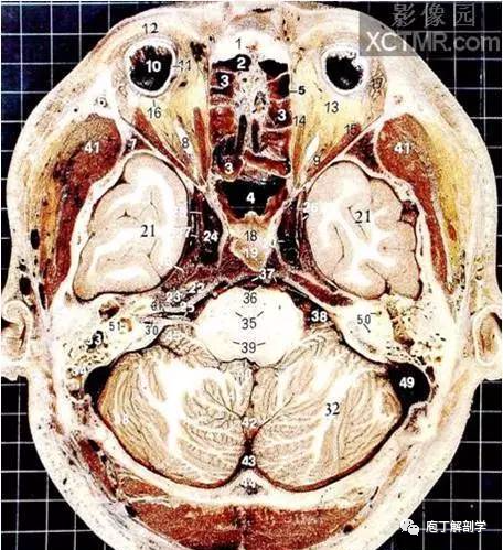 經典大體顱腦斷層解剖圖橫斷面