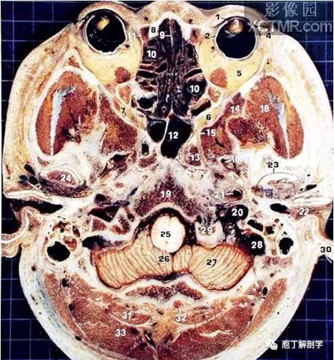 經典大體顱腦斷層解剖圖橫斷面