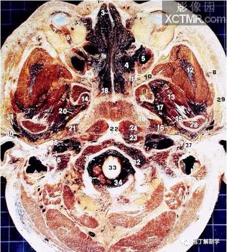 經典大體顱腦斷層解剖圖橫斷面