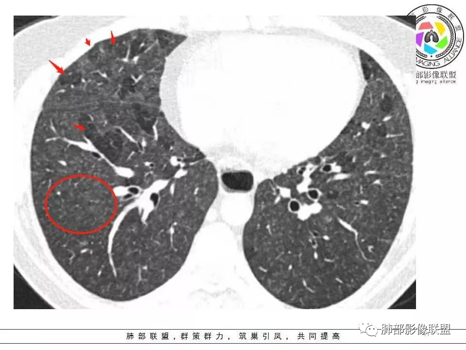 表現為濃淡不一磨玻璃密度影,慢性期表現為廣泛分佈的小結節及網格影