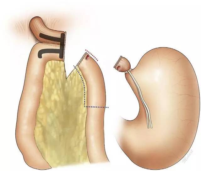 胃套扎手术示意图图片