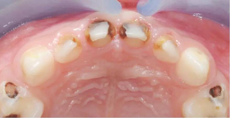 儿童龋齿充填术操作指南秦满教授