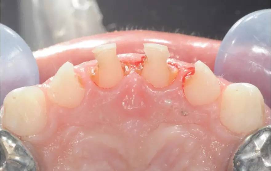 儿童龋齿充填术操作指南秦满教授