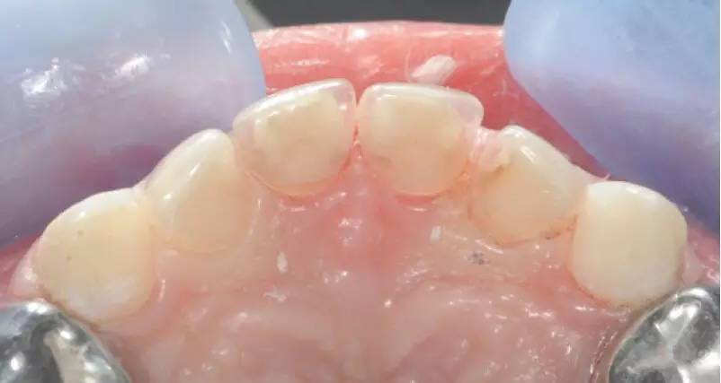 儿童龋齿充填术操作指南秦满教授