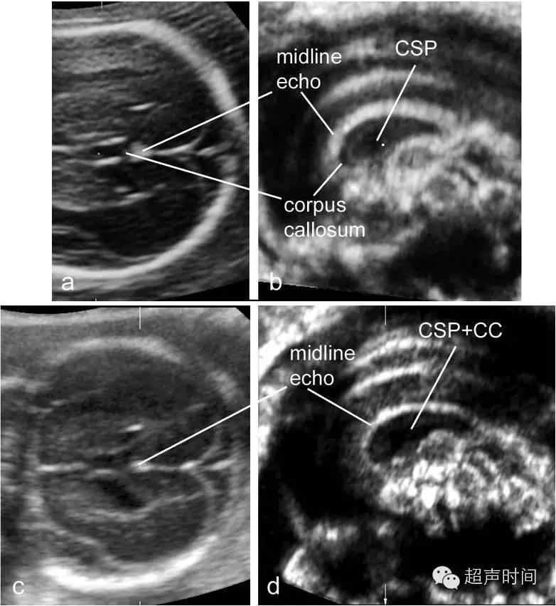 超聲如何完美顯示胎兒胼胝體